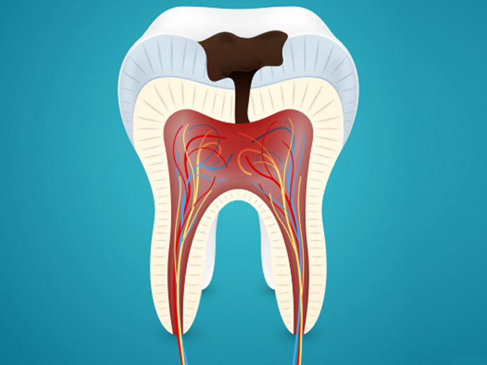 Caries-box