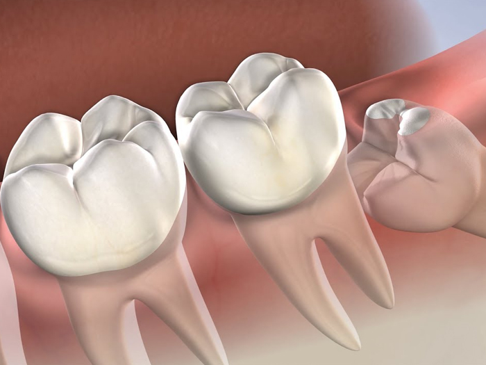 Cyst-below-wisdom-teeth-box