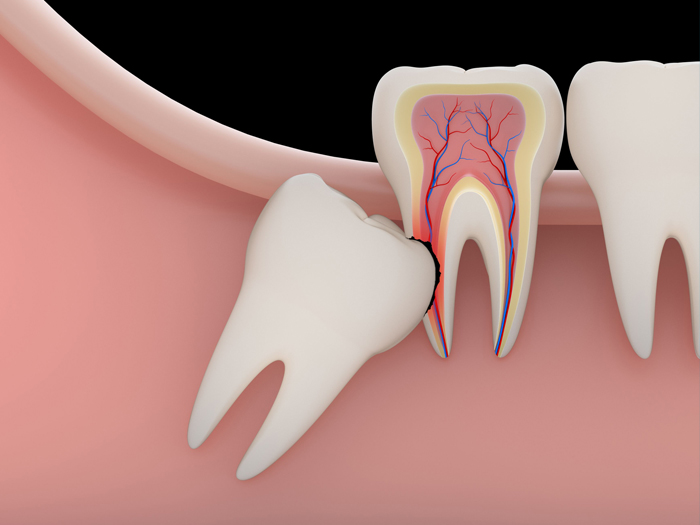 Infection-in-adjacent-tooth-box