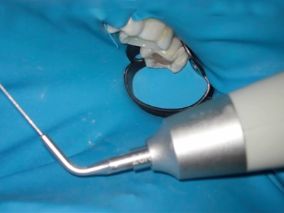 Ultrasonic-irrigation-1