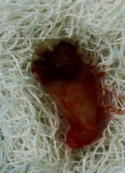 3rd-molar