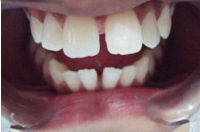 case 1 after
