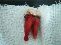 periapical-cyst