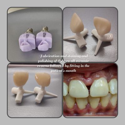 CEREC crown