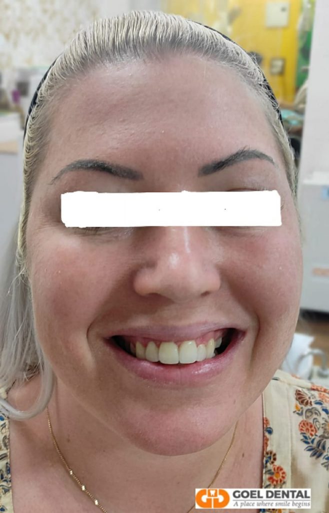 After veneers 6 upper Emax veneers
