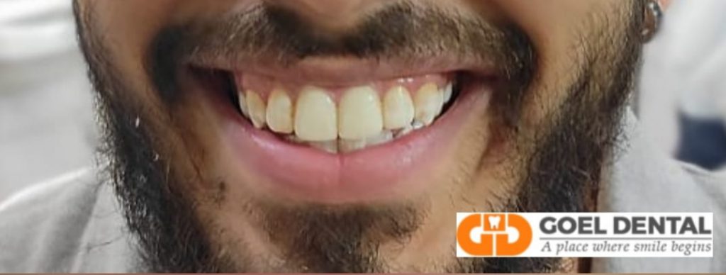 After veneers 2 front teeth veneers