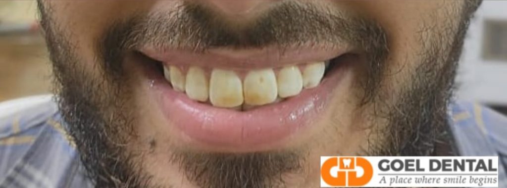 Before Veneers Teeth with stains