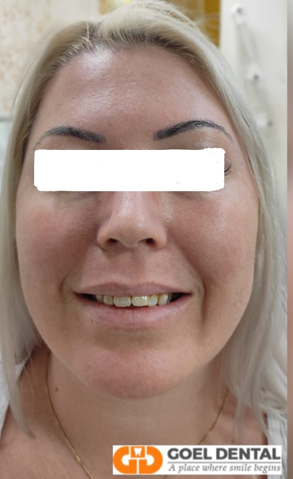 Before veneers Before veneers