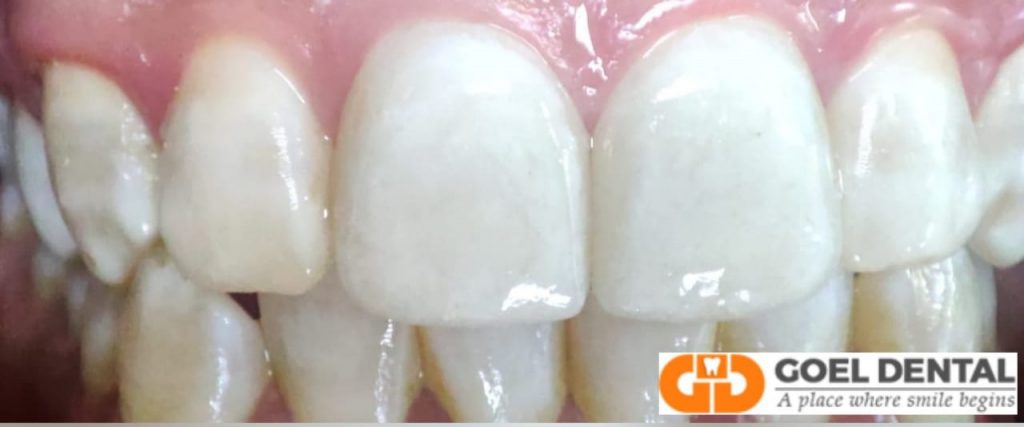 Close up of fixed veneers Close up of 2 upper front teeth veneers