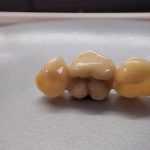Zirconia Dental Bridge Zirconia Dental Bridge