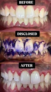 GBT Case Guided Biofilm Therapy