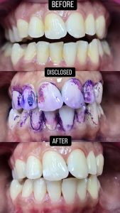 GBT case 4 Advanced teeth cleaning