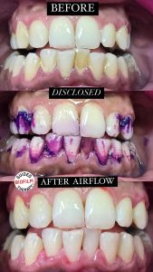PRE and POST GBT GBT therapy